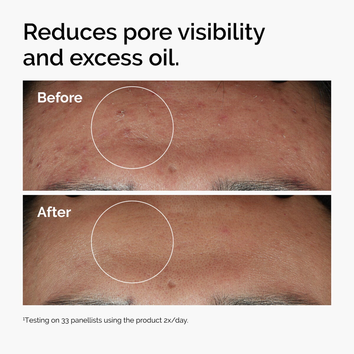 niacinamide-10-zinc-1-r0 ord-niacinamide-zinc-blemish-serum-before-after-pores.jpg