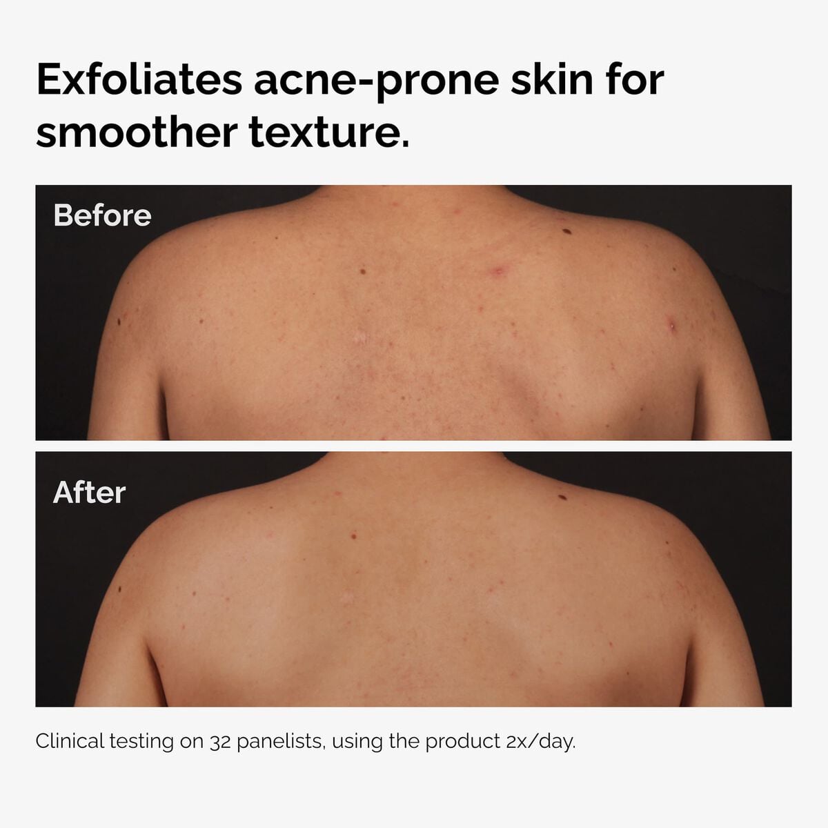 salicylic-acid-0-5-body-serum-i9 ord-salicylic-acid-body-serum-before-after-graphic-NA.jpg