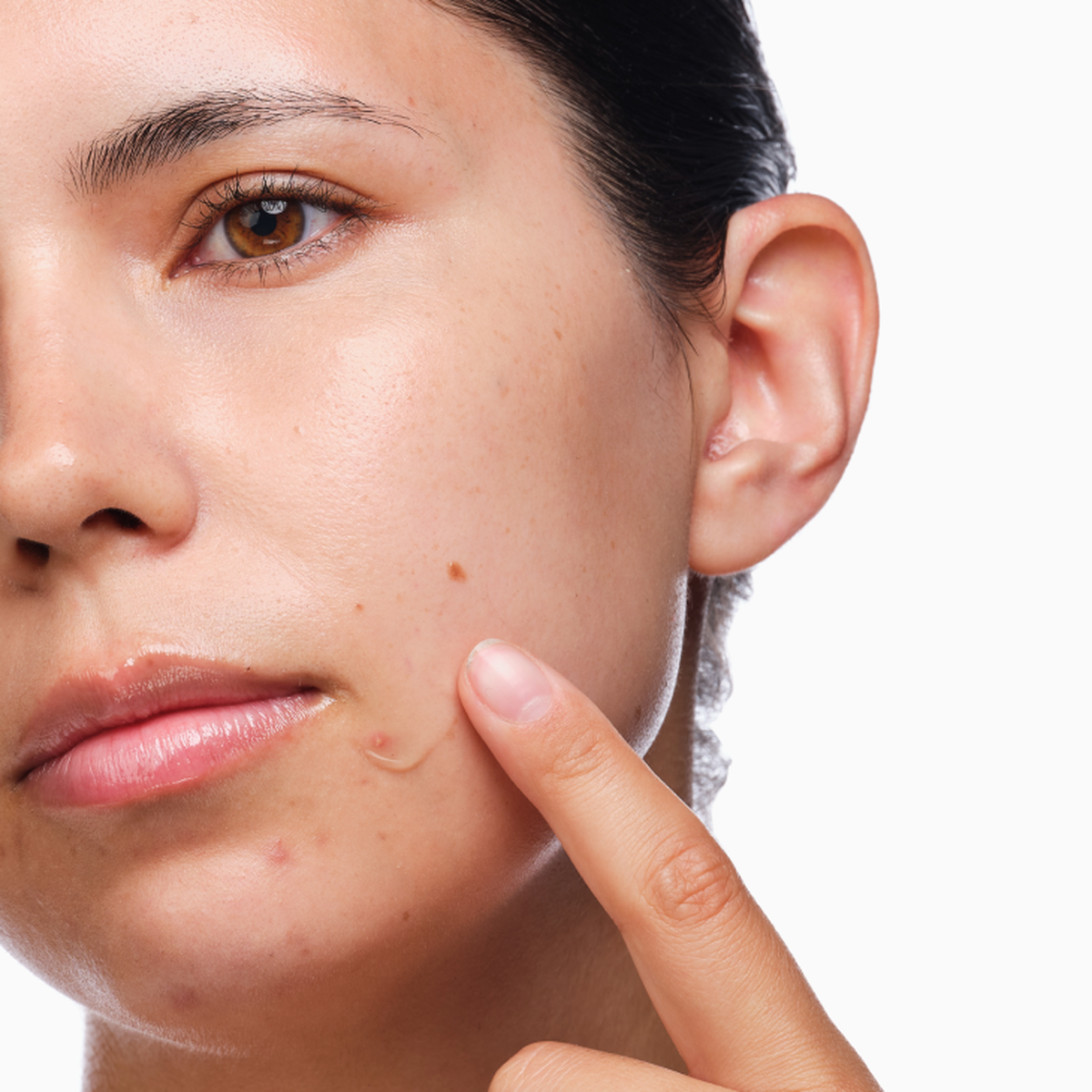 the-acne-set-d2 rdn-the-acne-set-application.png